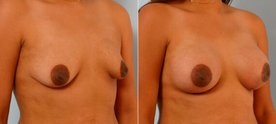 Breast Augmentation before and after photos in Houston, TX, Patient 25698
