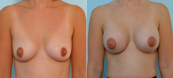 Breast Augmentation before and after photos in Houston, TX, Patient 25705