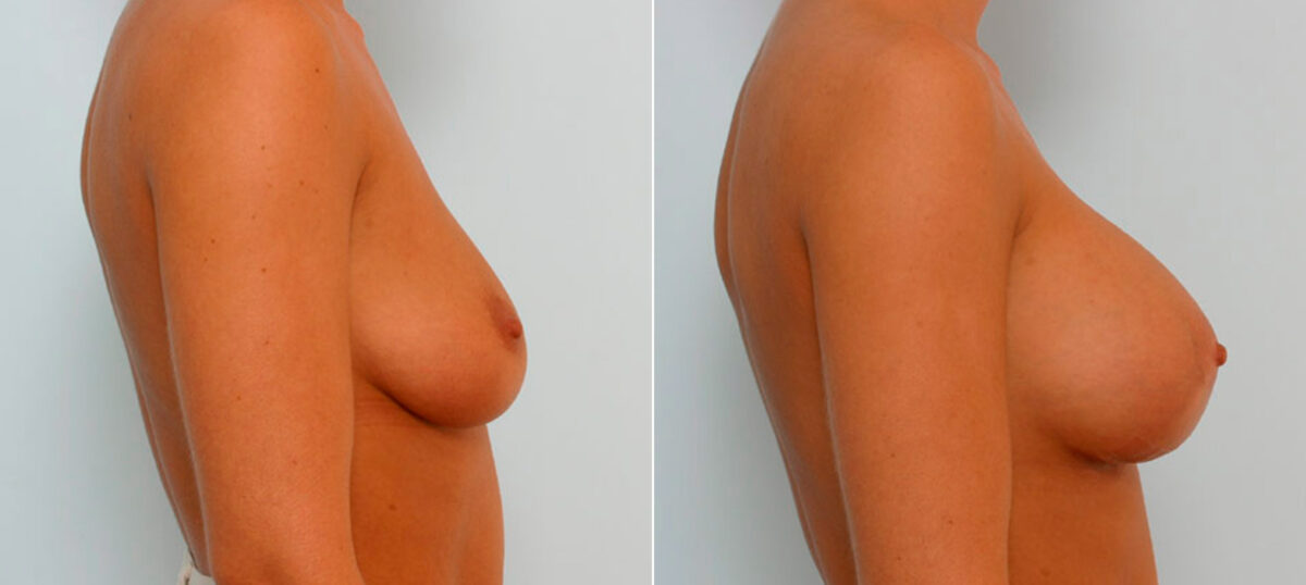 Breast Augmentation before and after photos in Houston, TX, Patient 25712