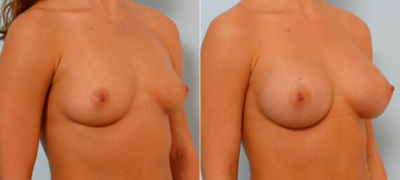 Breast Augmentation before and after photos in Houston, TX, Patient 25719