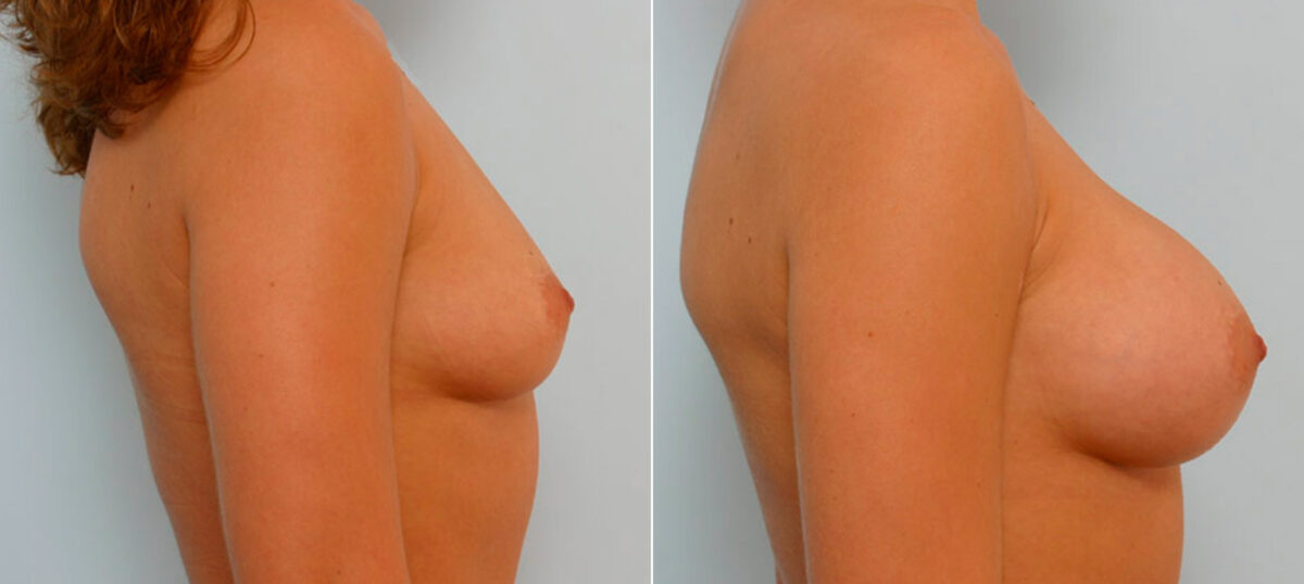 Breast Augmentation before and after photos in Houston, TX, Patient 25719