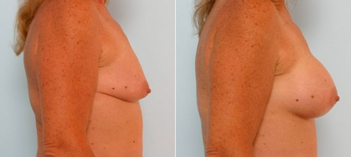 Breast Augmentation before and after photos in Houston, TX, Patient 25726