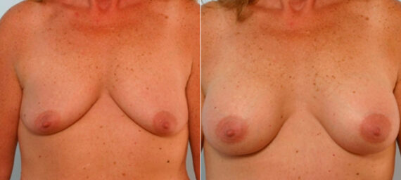 Breast Augmentation before and after photos in Houston, TX, Patient 25726