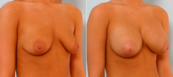 Breast Augmentation before and after photos in Houston, TX, Patient 25733