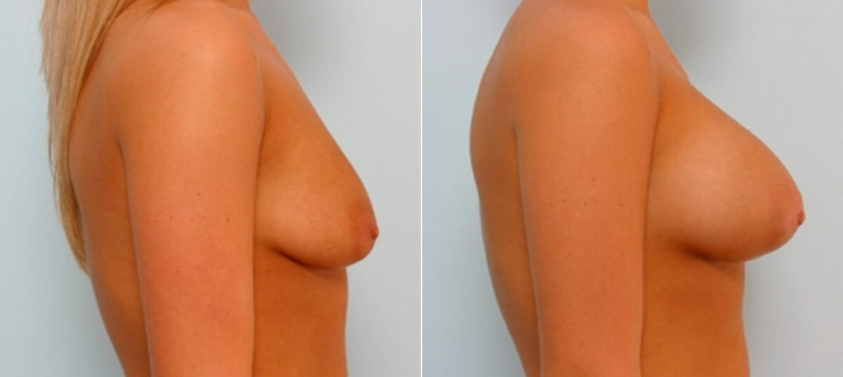 Breast Augmentation before and after photos in Houston, TX, Patient 25733