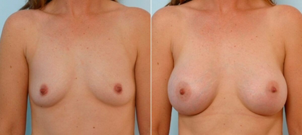 Breast Augmentation before and after photos in Houston, TX, Patient 25740
