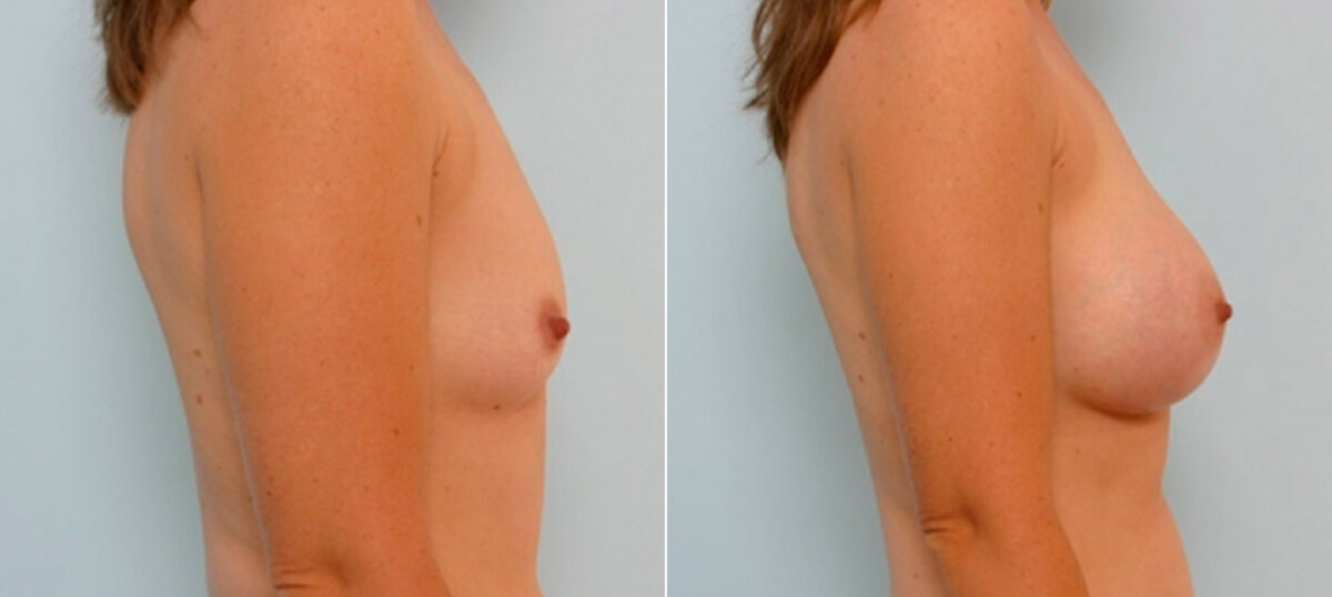 Breast Augmentation before and after photos in Houston, TX, Patient 25740