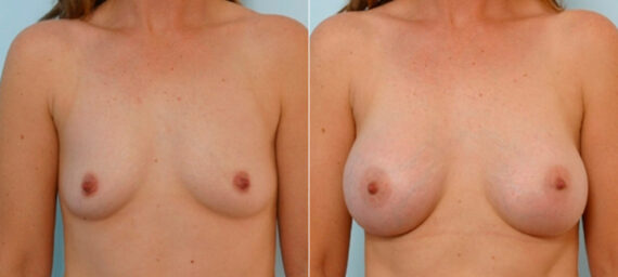 Breast Augmentation before and after photos in Houston, TX, Patient 25740