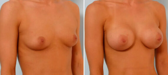 Breast Augmentation before and after photos in Houston, TX, Patient 25747
