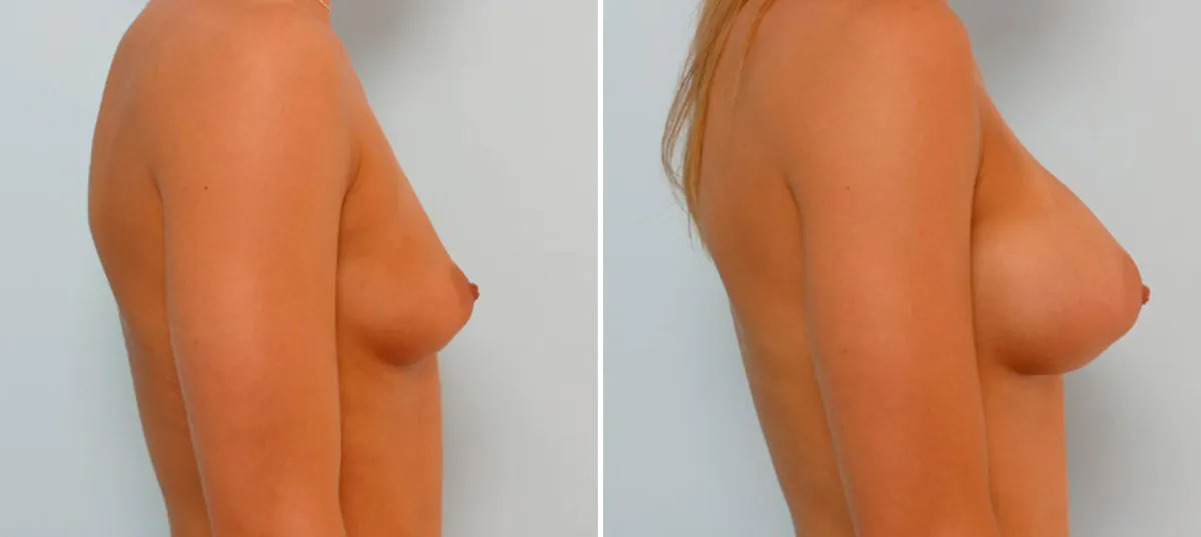 Breast Augmentation before and after photos in Houston, TX, Patient 25747