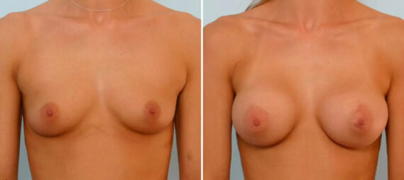 Breast Augmentation before and after photos in Houston, TX, Patient 25747