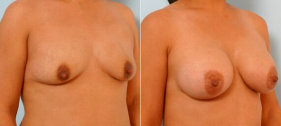 Breast Augmentation before and after photos in Houston, TX, Patient 25754