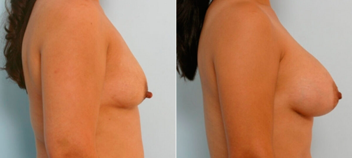 Breast Augmentation before and after photos in Houston, TX, Patient 25754