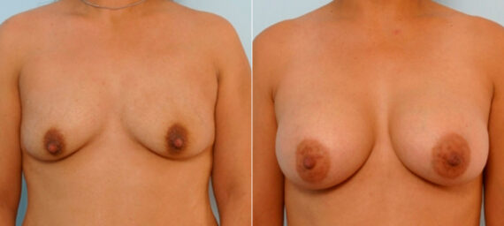 Breast Augmentation before and after photos in Houston, TX, Patient 25754