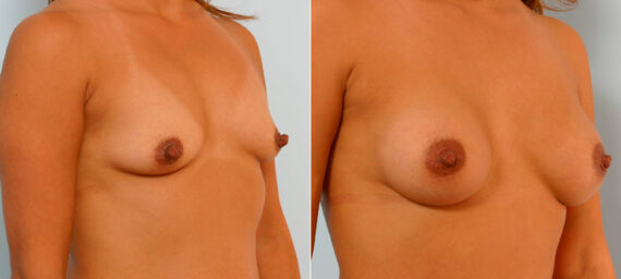 Breast Augmentation before and after photos in Houston, TX, Patient 25761