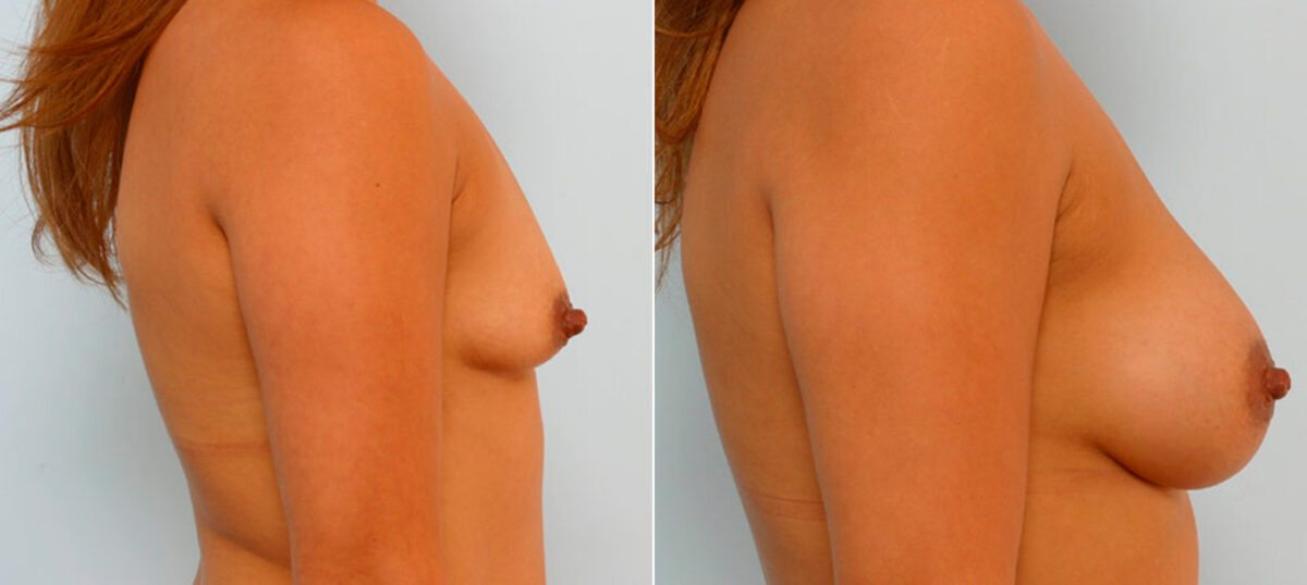 Breast Augmentation before and after photos in Houston, TX, Patient 25761