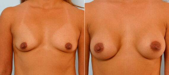 Breast Augmentation before and after photos in Houston, TX, Patient 25761