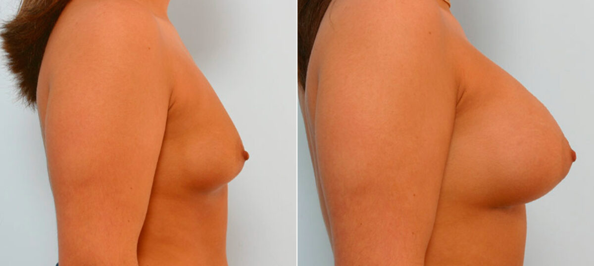 Breast Augmentation before and after photos in Houston, TX, Patient 25768