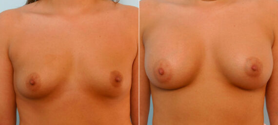 Breast Augmentation before and after photos in Houston, TX, Patient 25768