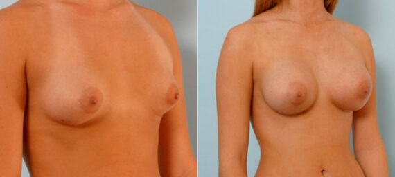 Breast Augmentation before and after photos in Houston, TX, Patient 25775