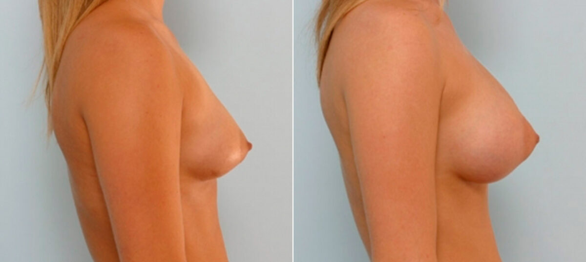 Breast Augmentation before and after photos in Houston, TX, Patient 25775