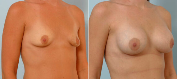 Breast Augmentation before and after photos in Houston, TX, Patient 25782