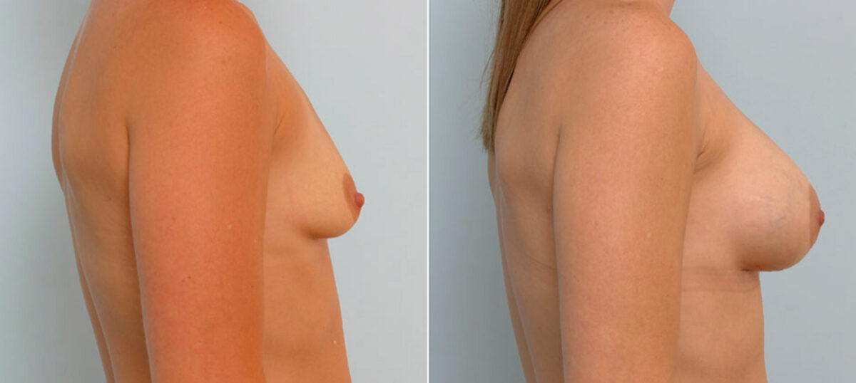 Breast Augmentation before and after photos in Houston, TX, Patient 25782