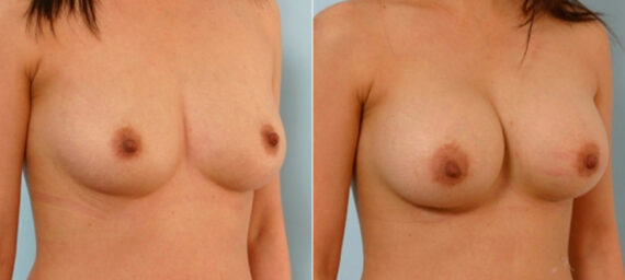 Breast Augmentation before and after photos in Houston, TX, Patient 25789