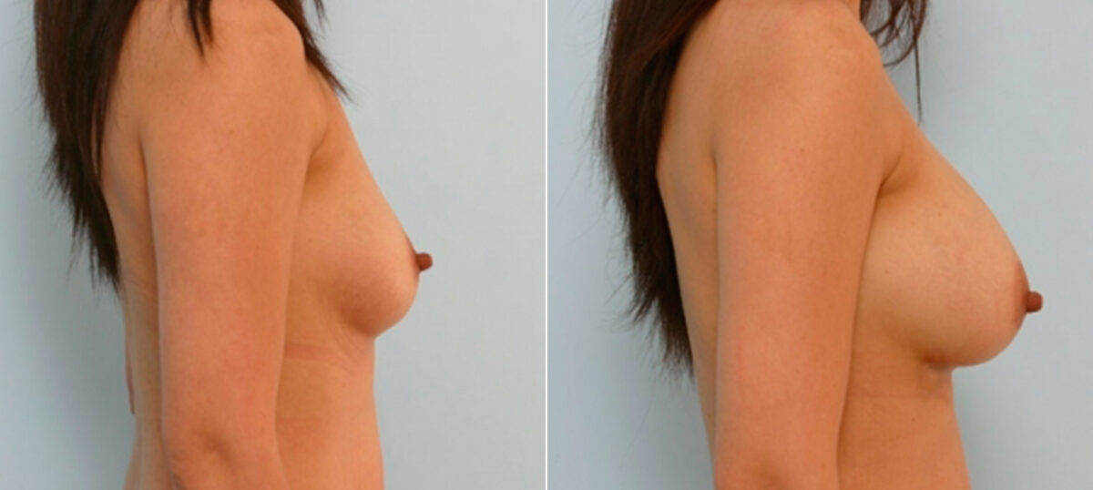 Breast Augmentation before and after photos in Houston, TX, Patient 25789