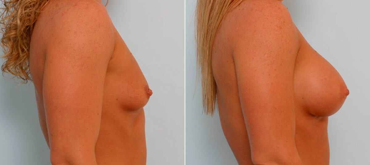 Breast Augmentation before and after photos in Houston, TX, Patient 25796