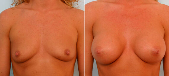 Breast Augmentation before and after photos in Houston, TX, Patient 25796