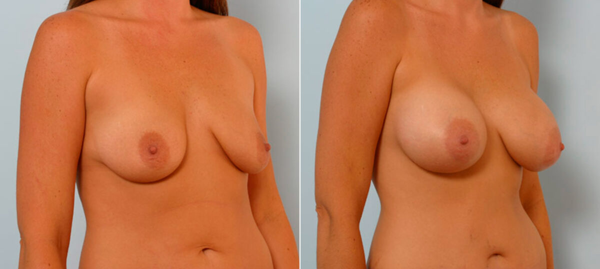 Breast Augmentation before and after photos in Houston, TX, Patient 25803