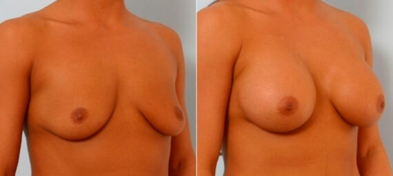 Breast Augmentation before and after photos in Houston, TX, Patient 25810