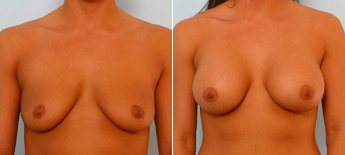 Breast Augmentation before and after photos in Houston, TX, Patient 25810