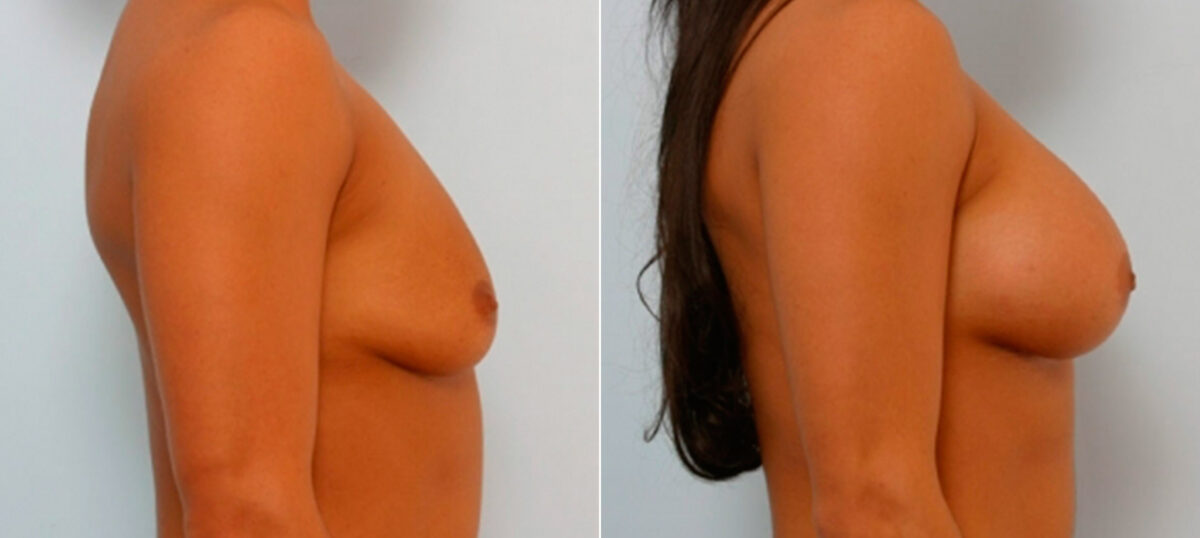 Breast Augmentation before and after photos in Houston, TX, Patient 25810