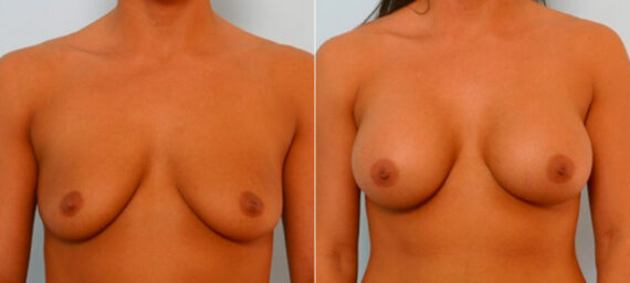 Breast Augmentation before and after photos in Houston, TX, Patient 25810