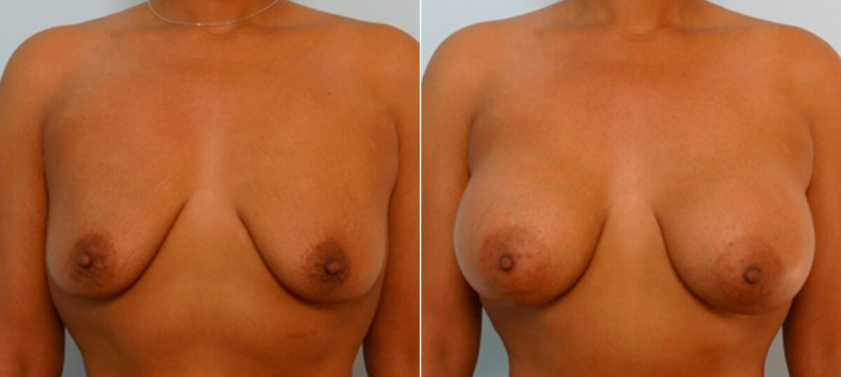 Breast Augmentation before and after photos in Houston, TX, Patient 25817