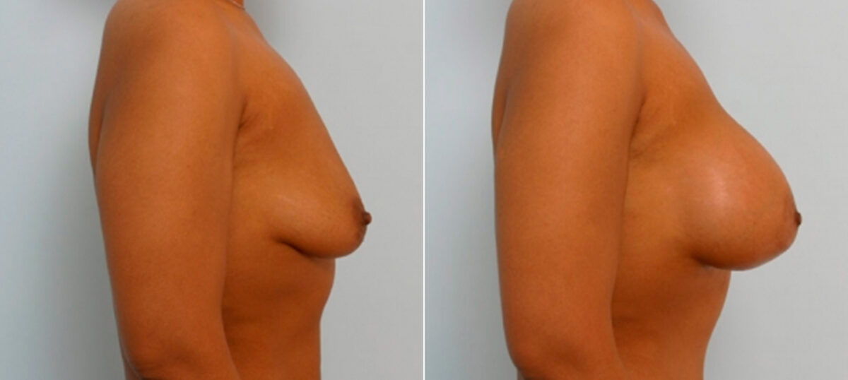 Breast Augmentation before and after photos in Houston, TX, Patient 25817