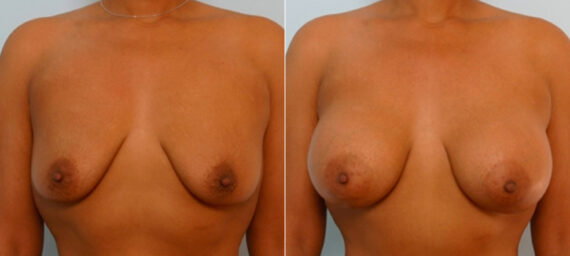 Breast Augmentation before and after photos in Houston, TX, Patient 25817
