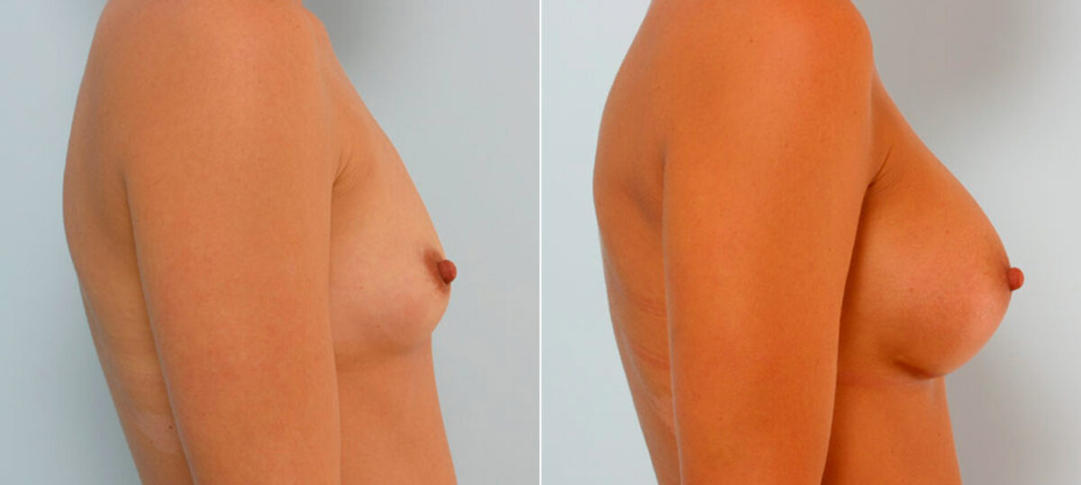 Breast Augmentation before and after photos in Houston, TX, Patient 25831