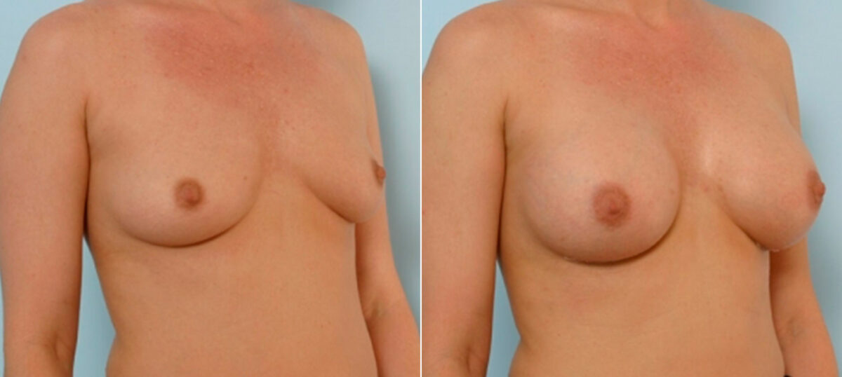 Breast Augmentation before and after photos in Houston, TX, Patient 25838