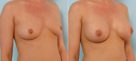 Breast Augmentation before and after photos in Houston, TX, Patient 25838