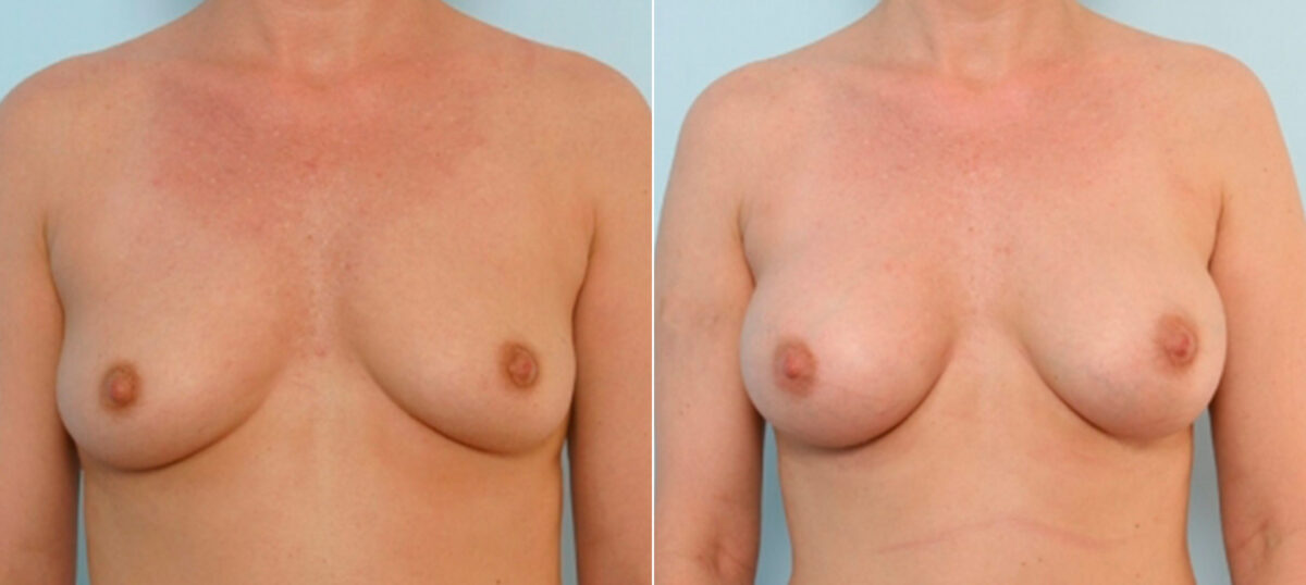 Breast Augmentation before and after photos in Houston, TX, Patient 25838