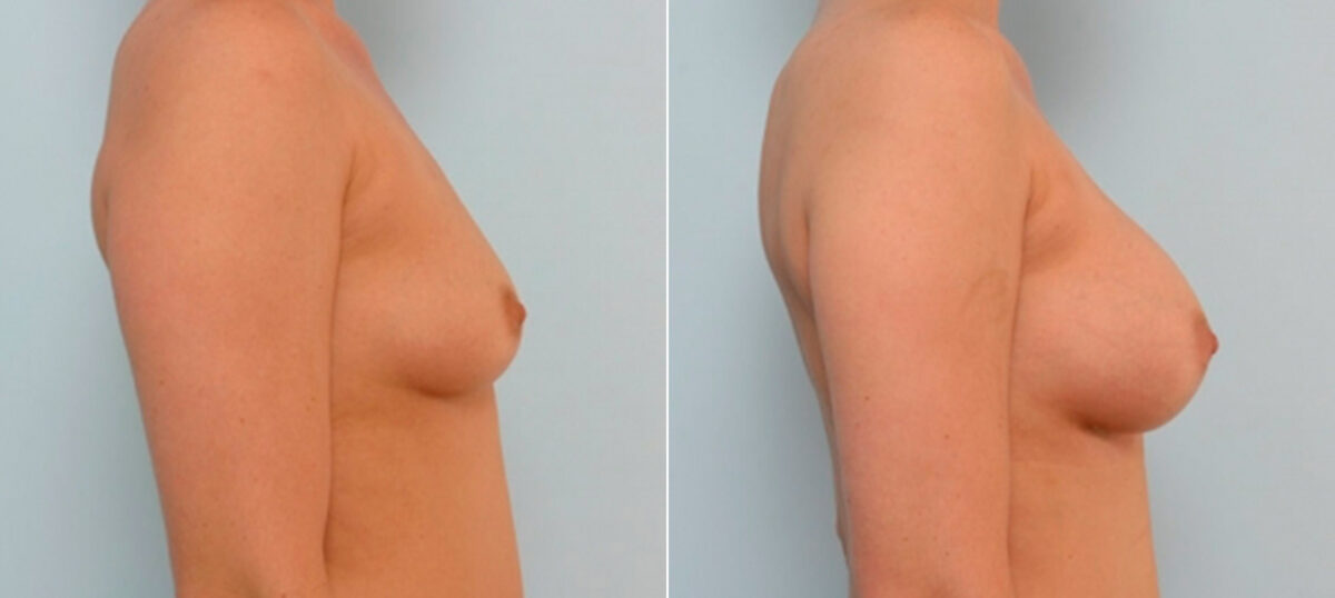 Breast Augmentation before and after photos in Houston, TX, Patient 25838