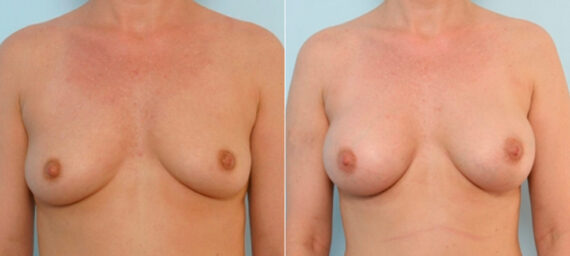 Breast Augmentation before and after photos in Houston, TX, Patient 25838