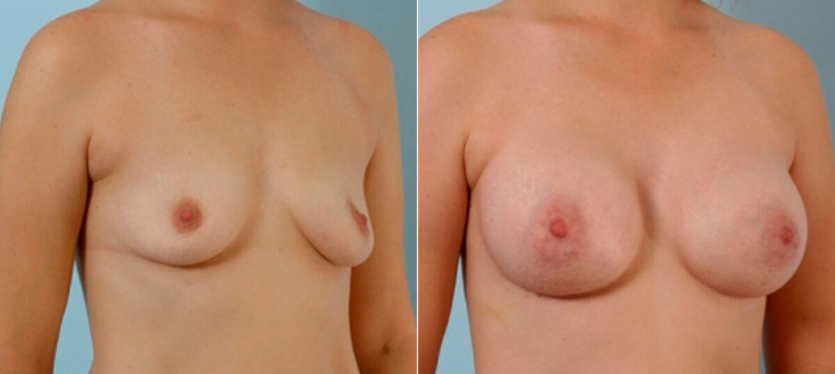 Breast Augmentation before and after photos in Houston, TX, Patient 25845