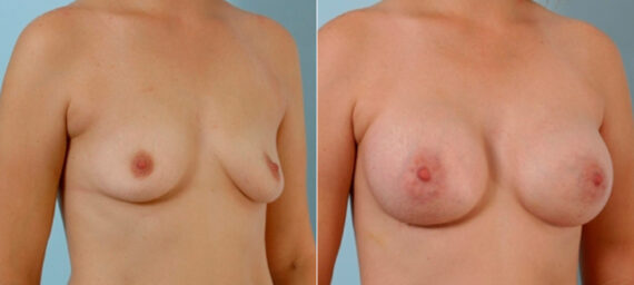 Breast Augmentation before and after photos in Houston, TX, Patient 25845