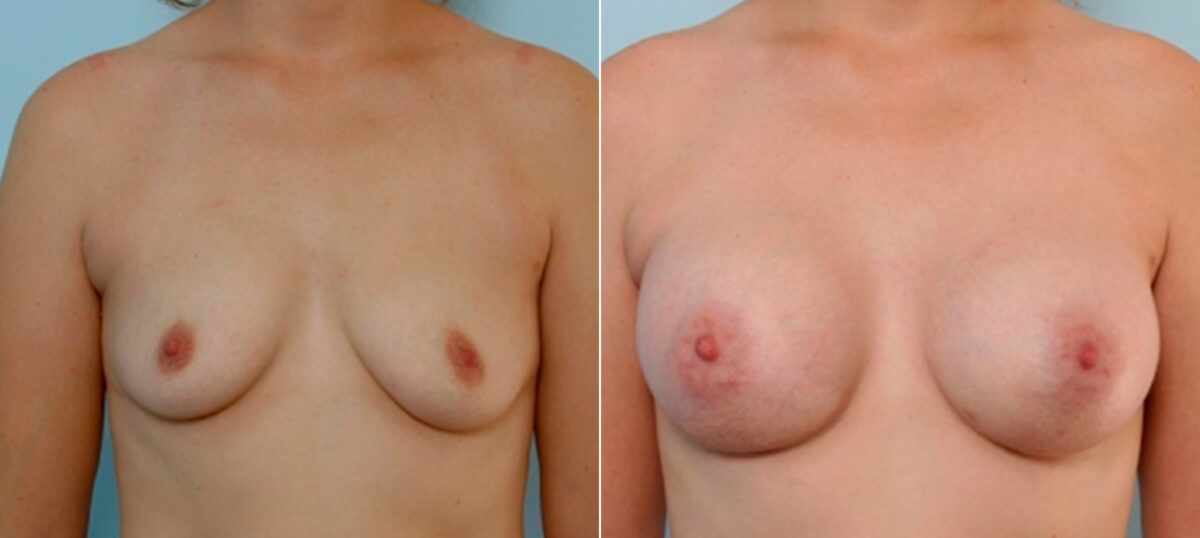 Breast Augmentation before and after photos in Houston, TX, Patient 25845