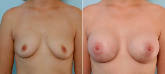 Breast Augmentation before and after photos in Houston, TX, Patient 25845