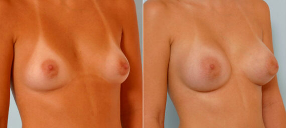 Breast Augmentation before and after photos in Houston, TX, Patient 25852